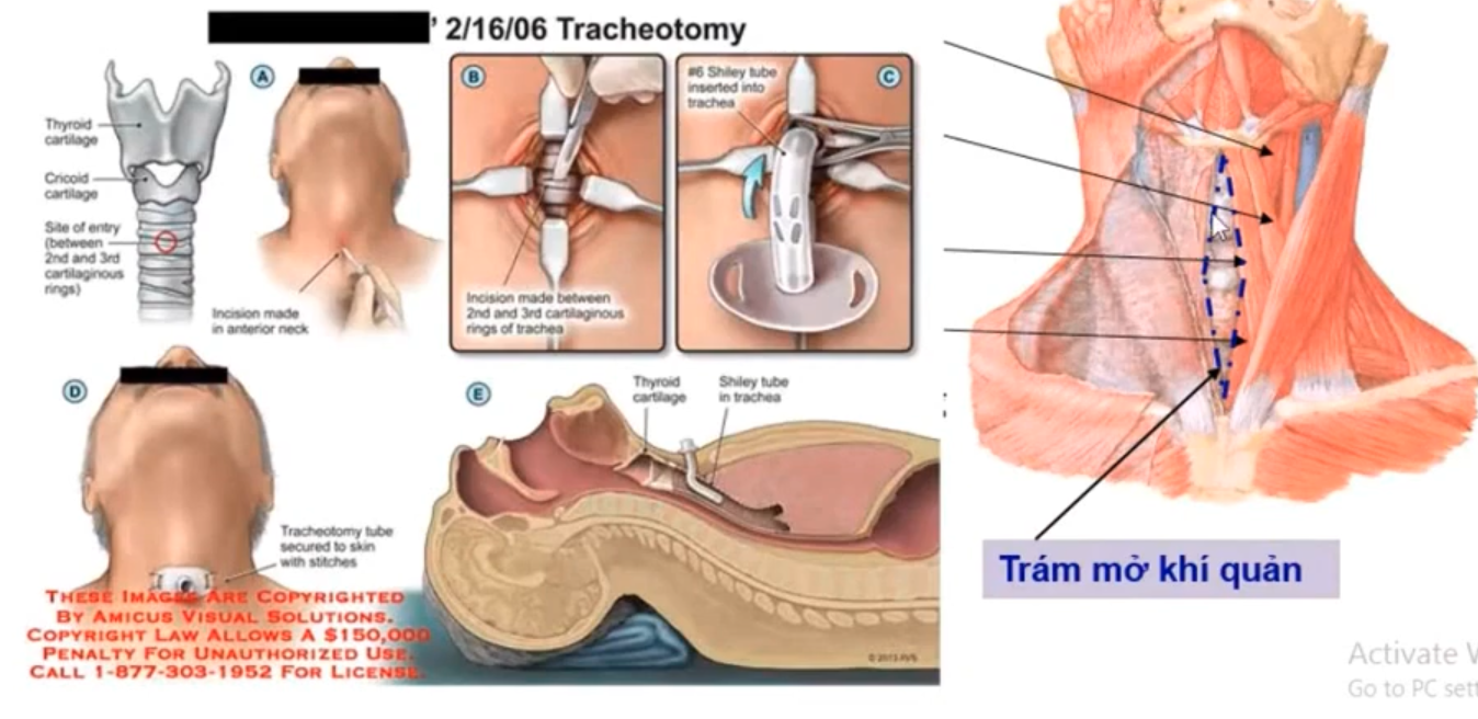 <p>Trong thủ thuật trám mở khí quản, đâu là chi tiết cần ưu tiên cần phải để tránh biến chứng nặng xảy ra trong lúc phẫu thuật, vị trí này thường nằm sụn khí quản (T2 - T4) </p>