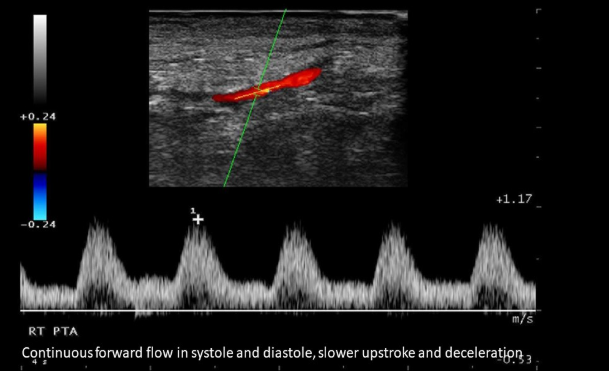 <ol><li><p>Slow upstroke </p></li><li><p>Slow deceleration </p></li><li><p>No diastolic flow reversal </p></li></ol><p></p>