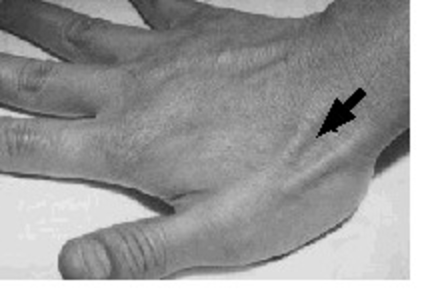 <p>Distal crease and floor of anatomical snuffbox.</p><p>origin of flexor pollicis brevis. Articulates with trapezium carpal bone via intercarpal joints.</p>