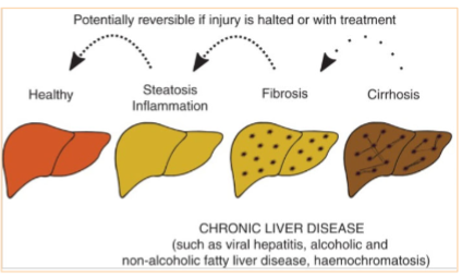 <p> Liver diseases can be acute or recurrent (chronic), focal or diffuse, mild or severe, and reversible or irreversible.</p><p> Inflammation/Steatosis</p><p> Liver fibrosis - formation of an abnormally large amount of scar tissue as it attempts to repair and replace damaged cells</p><p> Cirrhosis - chronic liver damage from a variety of causes leading to scarring and liver failure</p><p></p>