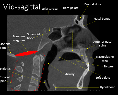 <p>anterior nasal spine</p>
