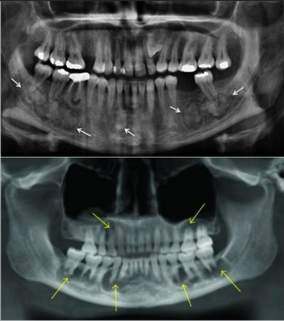 <ul><li><p>may have lesions in <u>post jaws</u>, some pts have lesions throughout </p></li><li><p>bilateral and symmetrical </p></li></ul><p></p>