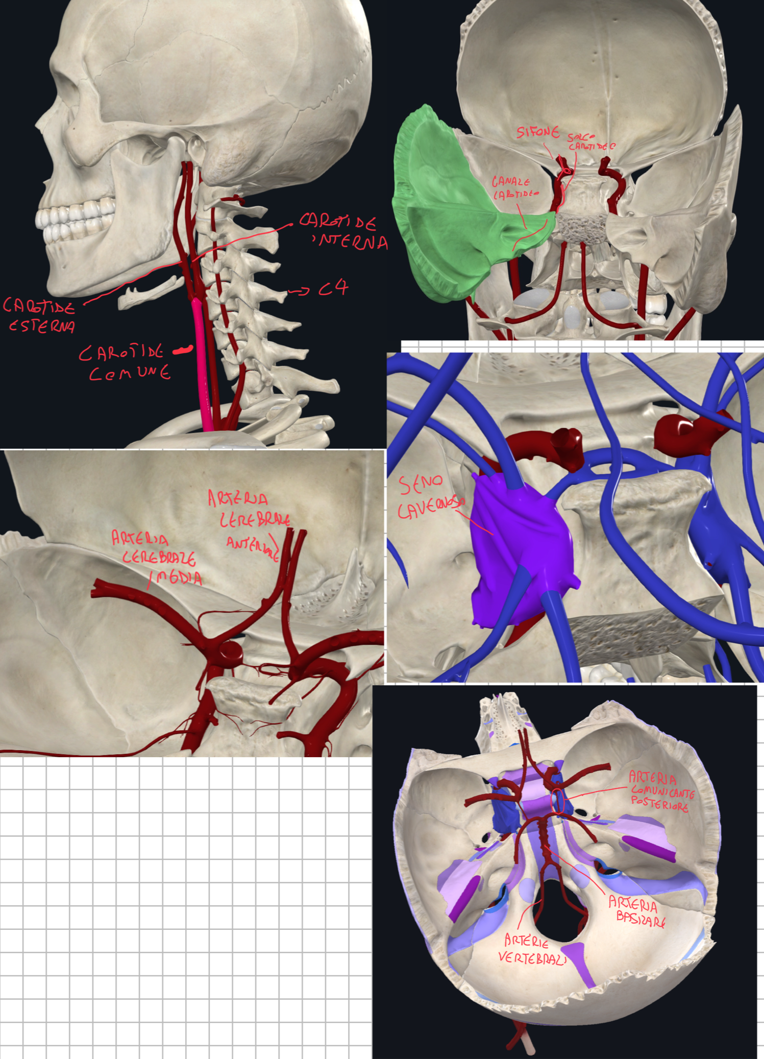 <p>L’Arteria Carotide Comune sale lungo il collo e a livello della 4 vertebra cervicale (C4) si divide in:</p><ul><li><p>Carotide Esterna che con i suoi rami irrora principalmente le strutture del viscerocranio</p></li><li><p>Carotide Interna: continua a salire verso la base cranica e penetra attraverso il canale carotideo dell’osso temporale</p></li></ul><p>Arteria Carotide Interna:</p><ul><li><p>Attraversato l’osso temporale si porta lateralmente al corpo dello sfenoide lungo il solco carotideo.</p></li><li><p>Qui attraversa il seno cavernoso della dura madre</p></li><li><p>Poi ripiega su se stessa a livello del processo clinoideo anteriore (questo ripiegamento è detto Sifone Carotideo)</p></li><li><p>Infine, emerge dal seno cavernoso originando:</p><ul><li><p>Arteria cerebrale media e anteriore</p></li><li><p>Questi rami partecipano al poligono di willis insieme alle arterie cerebrali posteriori che sono rami dell’arteria basilare (che a sua volta nasce dall’unione delle arterie vertebrali)</p></li></ul></li></ul><p></p>