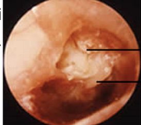 <ul><li><p>Accumulation of dead, exfoliated skin cells from the external canal and lateral surface of the tympanic membrane also referred to as a keratoma (similar only)</p></li><li><p>Can form at any perforation site, but is most often seen on the edge of the tympanic membrane, or the upper area of the tympanic membrane when it is pulled into the middle ear space due to eustachian tube dysfunction.</p></li><li><p>Smooth, white, pearl-like growths that can erode the ME ossicles completely and may enlarge and erode into the brain cavity</p></li><li><p>Mild conductive hearing loss that is&nbsp;usually treated by surgical removal&nbsp;first and may ultimately result in the&nbsp;use of a hearing ai</p></li></ul>