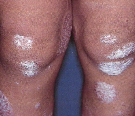 <p>Secondary Skin Lesion</p>