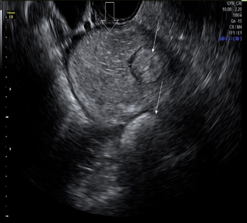 <p>a rokitansky nodule is commonly identified with what type of pelvic mass</p><p>a) cystic teratoma</p><p>b) serous cystadenoma</p><p>c) mucinous cystadenoma</p><p>d) focal adenomyosis </p>
