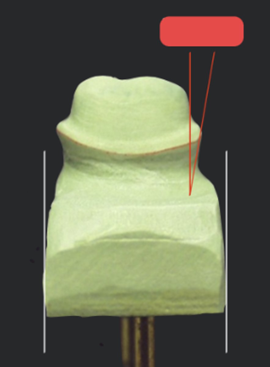 <p>Physiologic ditching occurs at __ degrees, if no or very short axial contour exist</p>