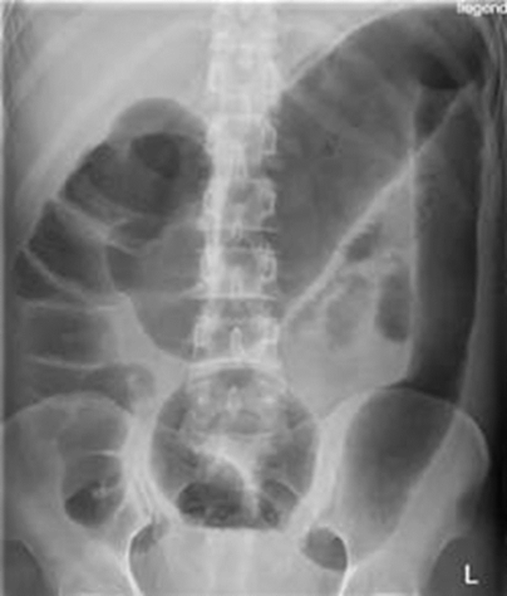 <p>-plain radiograph: long air-filled colon >6 cm in diameter, loss of haustra, "thumb printing", mucosal nodules</p><p>-leukocytosis</p>