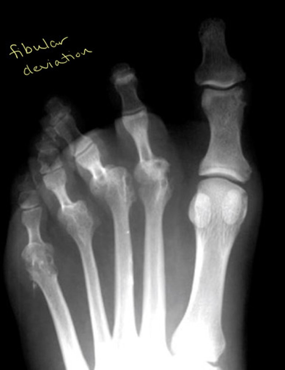 <p>Fibular deviation</p>