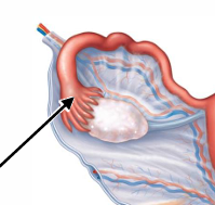 <p>Suspended over each ovary</p>