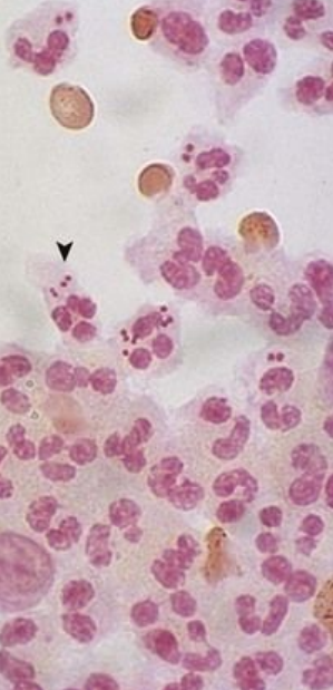 <p>8.7 Side A (PBD9: 368; BP9: 317)<br></p>
<p><br></p>
<p>Questions<br></p>
<p>A 19-year-old woman develops acute meningitis with fever, nuchal rigidity, and low CSF glucose. Gram stain is shown.<br></p>
<p><br></p>
<p>1. What inflammatory cells are shown?<br></p>
<p>2. What organism is pictured?<br></p>
<p>3. Explain the CSF findings.<br></p>