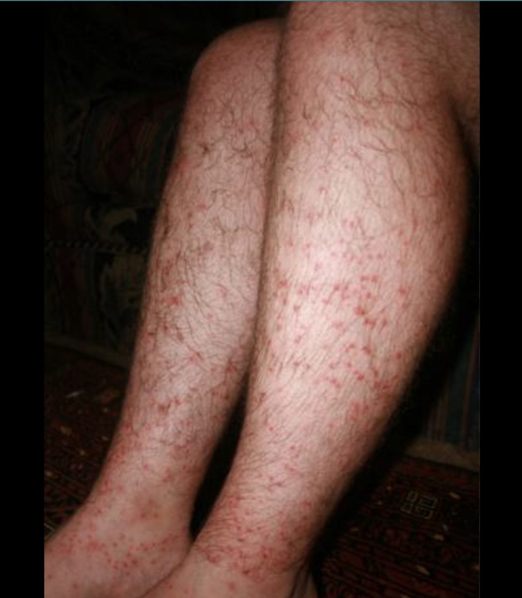 <p>Lives in shrubbery, trees, grass</p><ul><li><p>multiple bites that cause intense itching</p></li></ul><p></p>