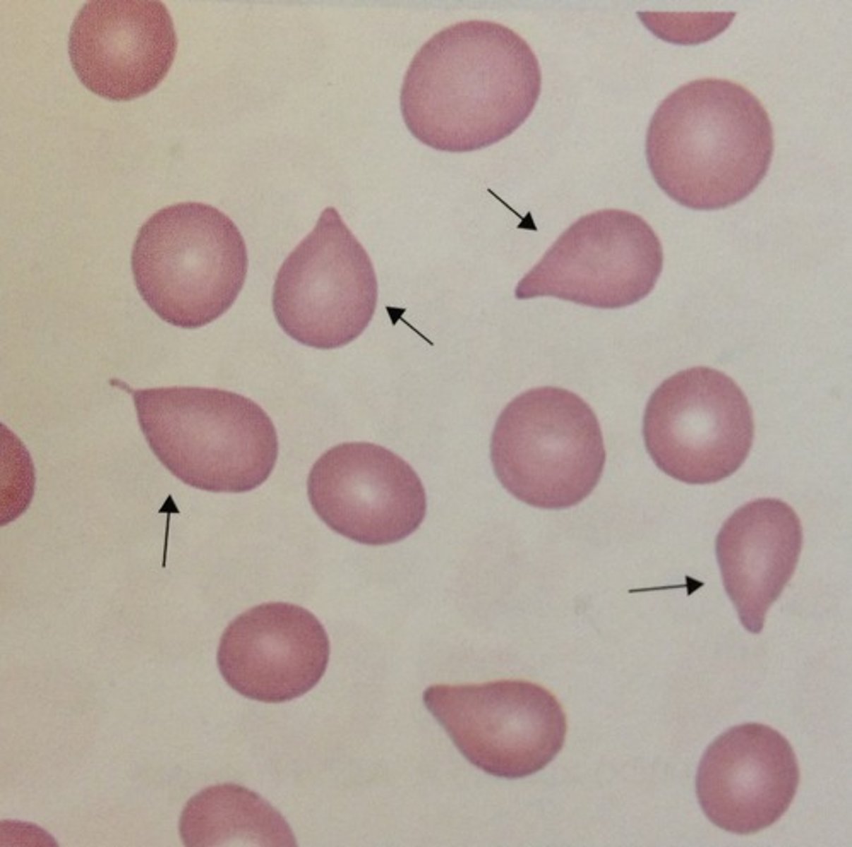<p>primary myelofibrosis</p>