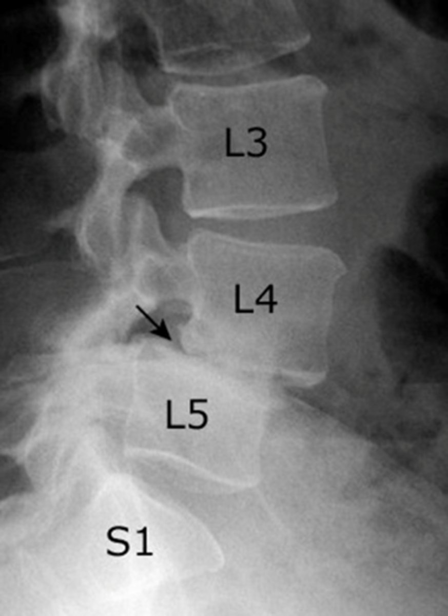 <p>forward slipping of one vertebra over another ( L4 &amp; L5 or L5 &amp; S1)</p>