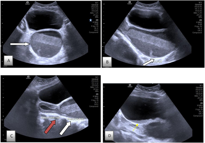 <p><strong><mark data-color="yellow" style="background-color: yellow; color: inherit;"><u>MC congenital abnormality in the female GI TRACT</u></mark></strong></p><ul><li><p>results in</p><ul><li><p>hydrometra</p></li><li><p>hematometra</p></li><li><p>pyometra</p></li></ul></li></ul><p></p>
