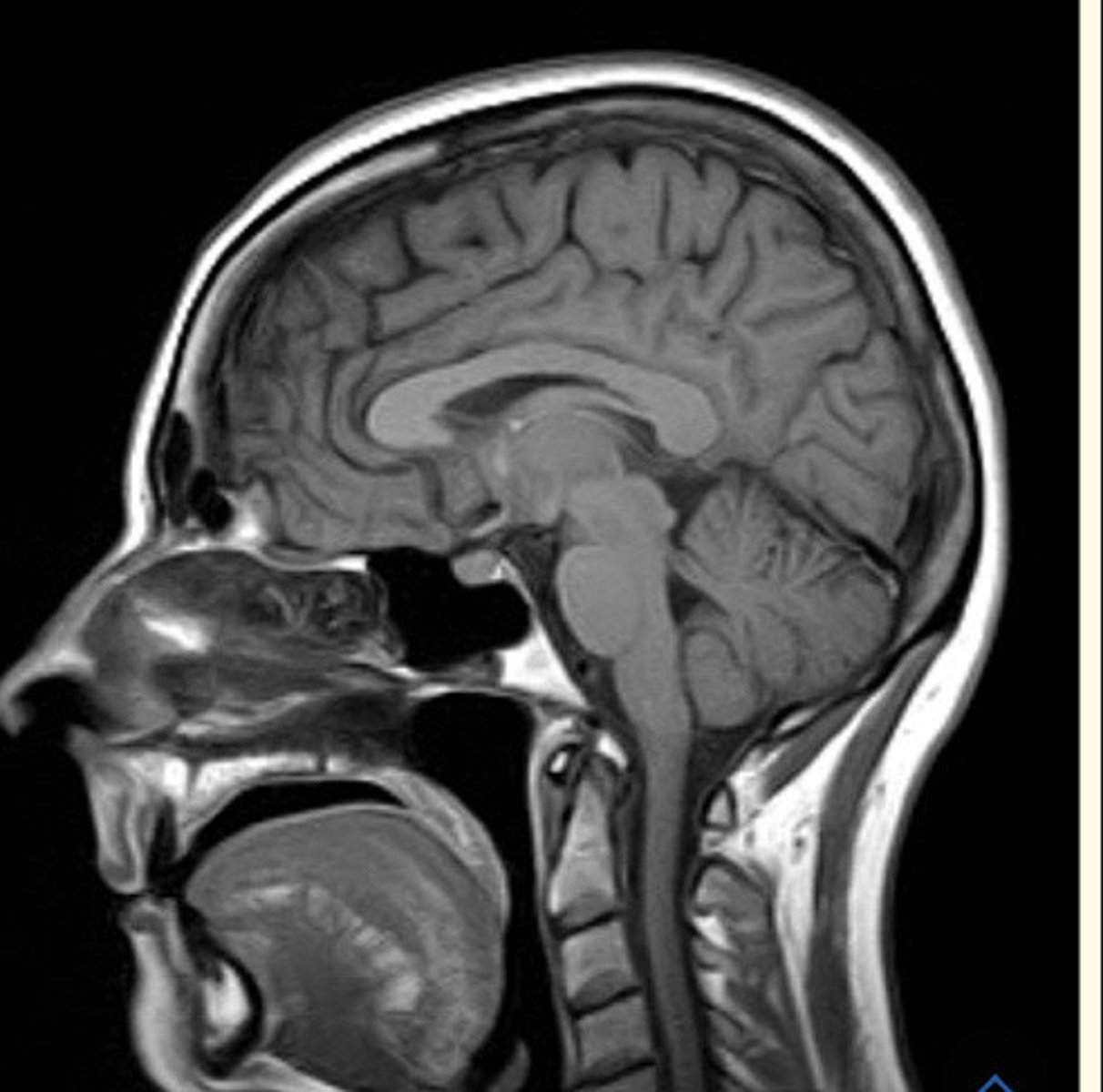 <p>What anatomical plane is this MRI scan of the head taken?</p>