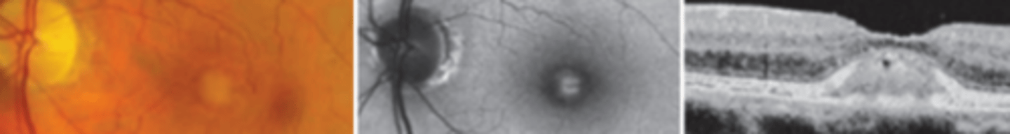 <p>an autosomal dominant disease presenting in the 4th-6th decade as macular lesions often centered by a pigmented spot and darkened border, possibly a milder form of best's disease. Is asymptomatic to mild often misdiagnosed as early AMD. There is no treatment, but prognosis is good unless a CNVM forms.</p>