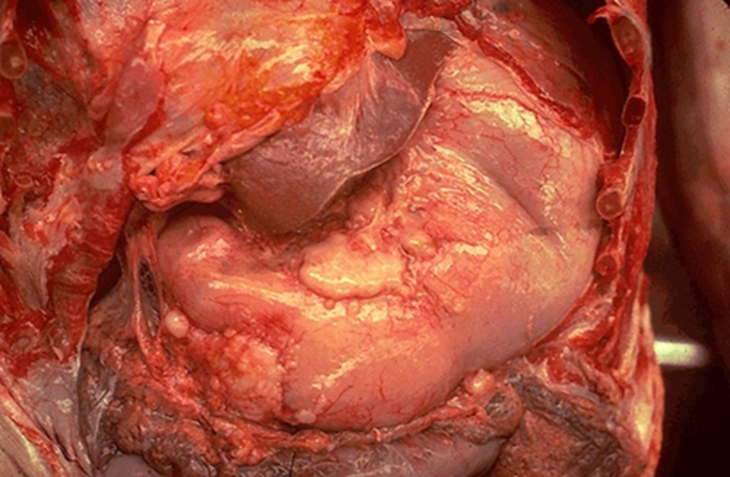 <p>cancer cell producing proteases that break down extracellular matrix and basement membranes</p><p>loss of adhesion molecules allow them to now spread into tissues</p>