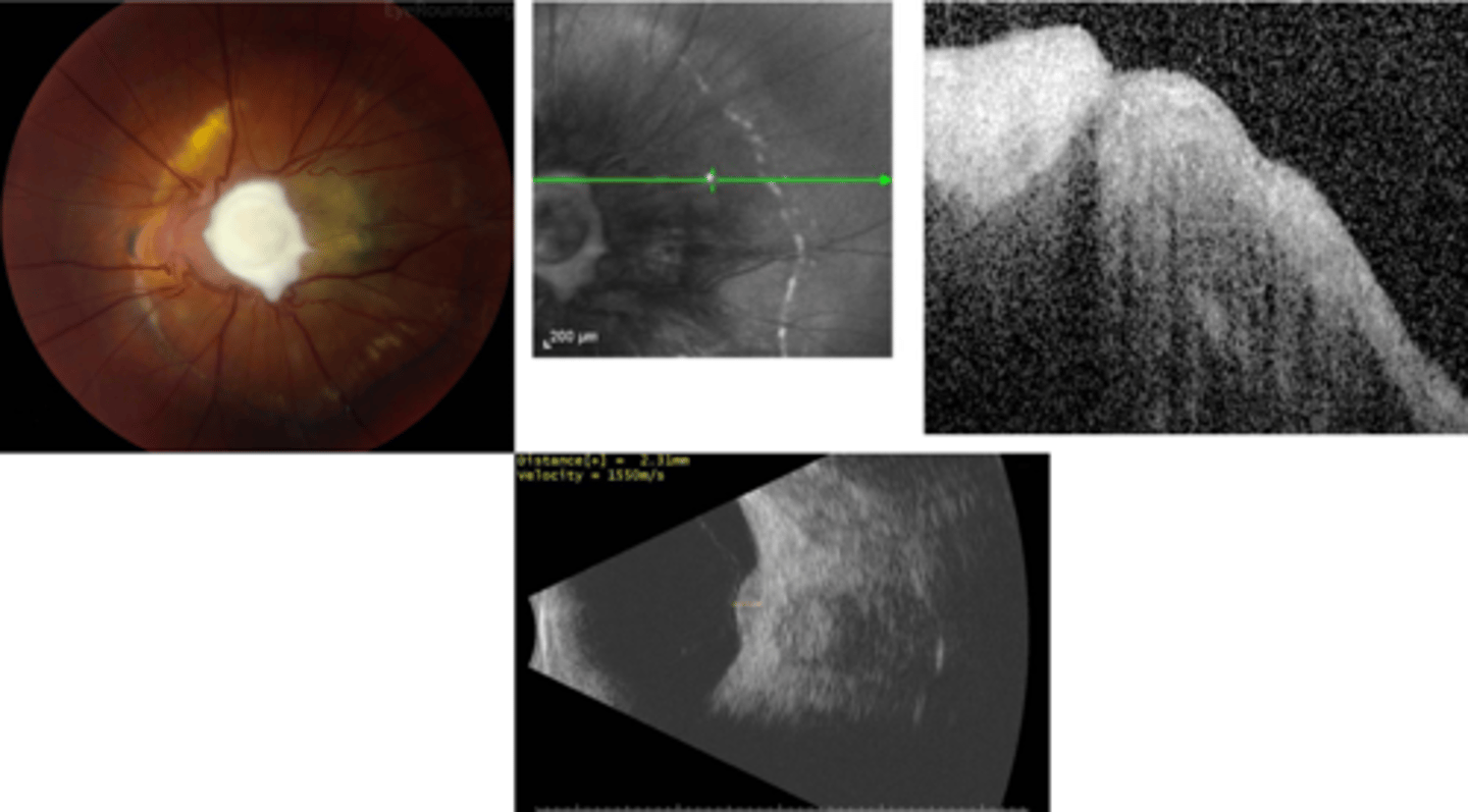 <p>granuloma mass over ONH = high-reflectivity</p>