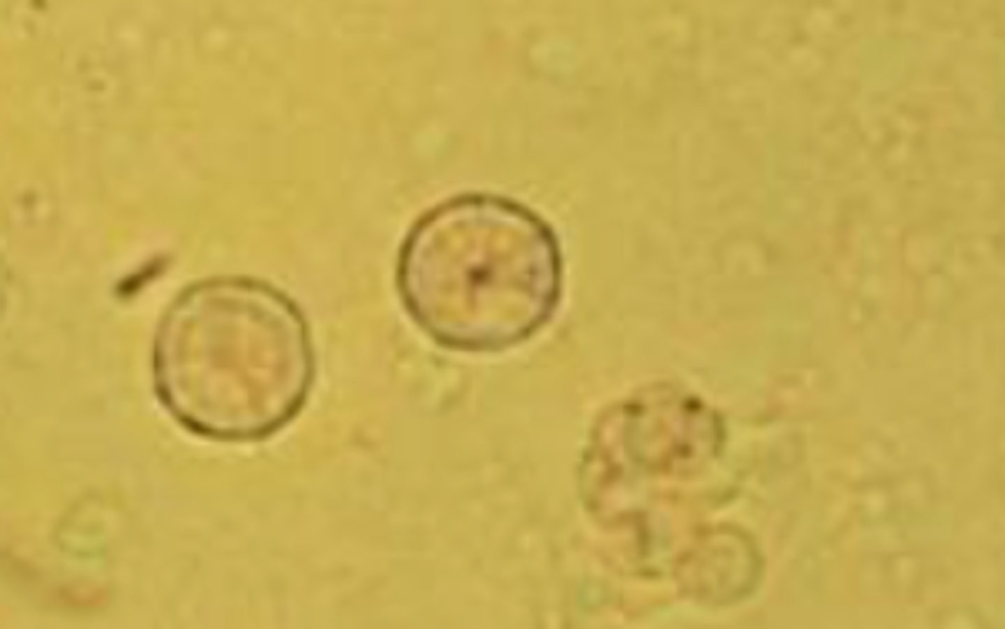 <p>- Shaped like a pin cushion or wheel</p><p>- Yellow or brown in color</p><p>- Indicate liver disease</p>