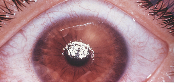 <p>Scratches on the cornea. </p>