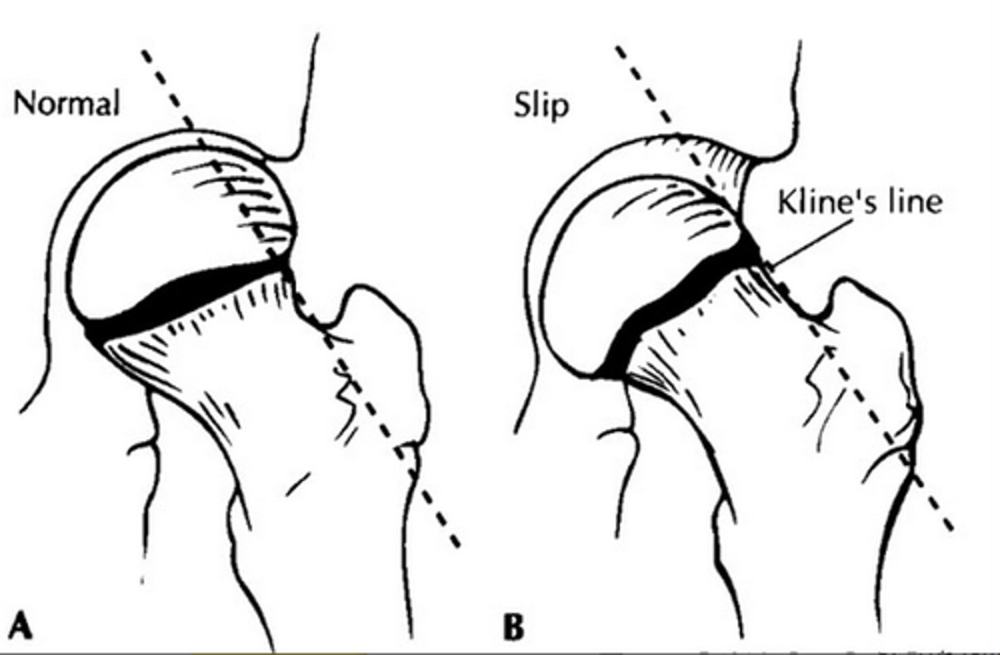 <p>if the line drawn on the surperior surface of the femoral neck DOES NOT pass through a portion of the head</p>