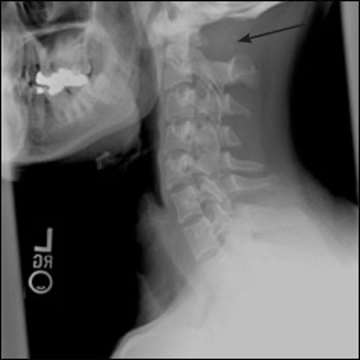 <p>Vignette # 3</p><p>Sex: Female</p><p>Age: 24</p><p>Chief Complaint: Patient presents with headaches and neck pain. She tells you that she has muscle spasms around the suboccipital region.</p><p>Diagnostic Imaging: X-ray</p><p>1. What are your differential diagnoses? (Choose 3)</p><p>a. Multiple myeloma</p><p>b. Lytic metastasis of the occiput</p><p>c. Agenesis of the posterior arch</p><p>d. Occipitalization</p><p>e. Hypertrophy of the anterior tubercle</p>