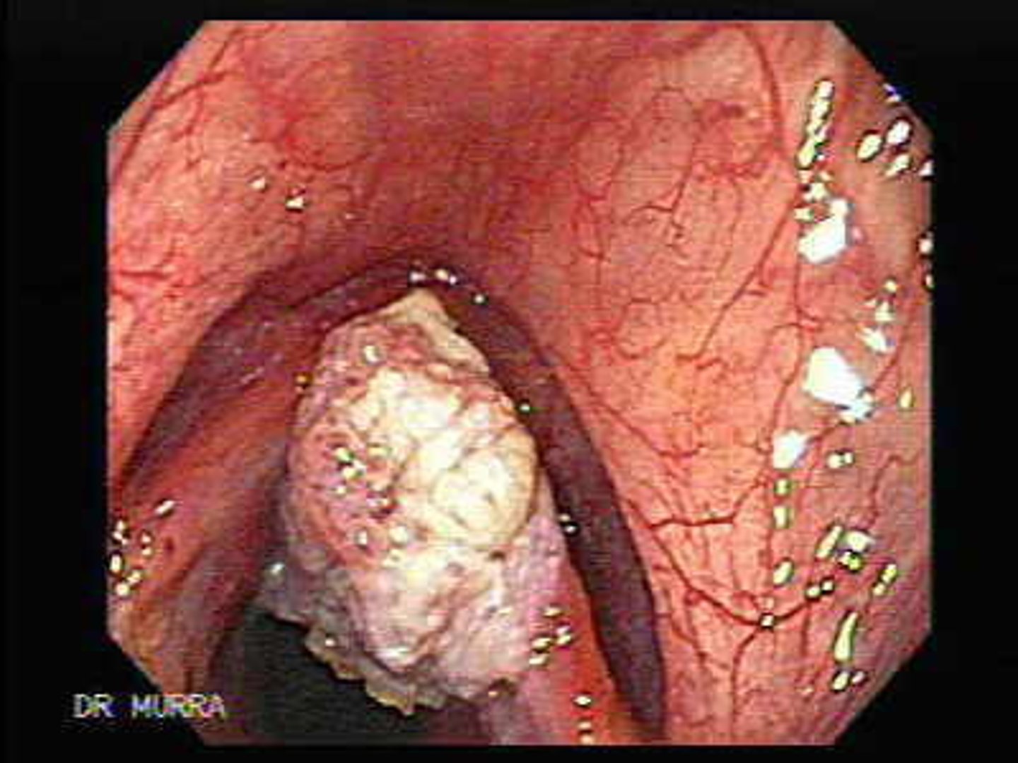 <p>- Adv. Age</p><p>- Male gender</p><p>- Occupation exposure—Nickel</p><p>- Alcohol abuse</p>