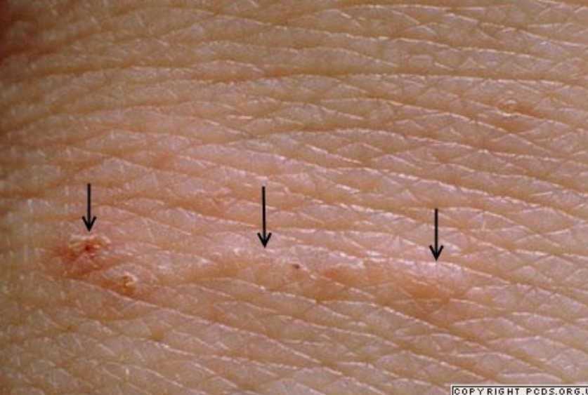 <p>what type of lesion is depicted, describe it, what condition is it</p>