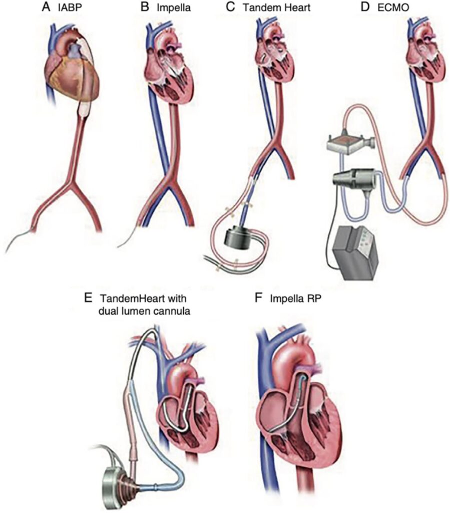 <p>ECMO</p>