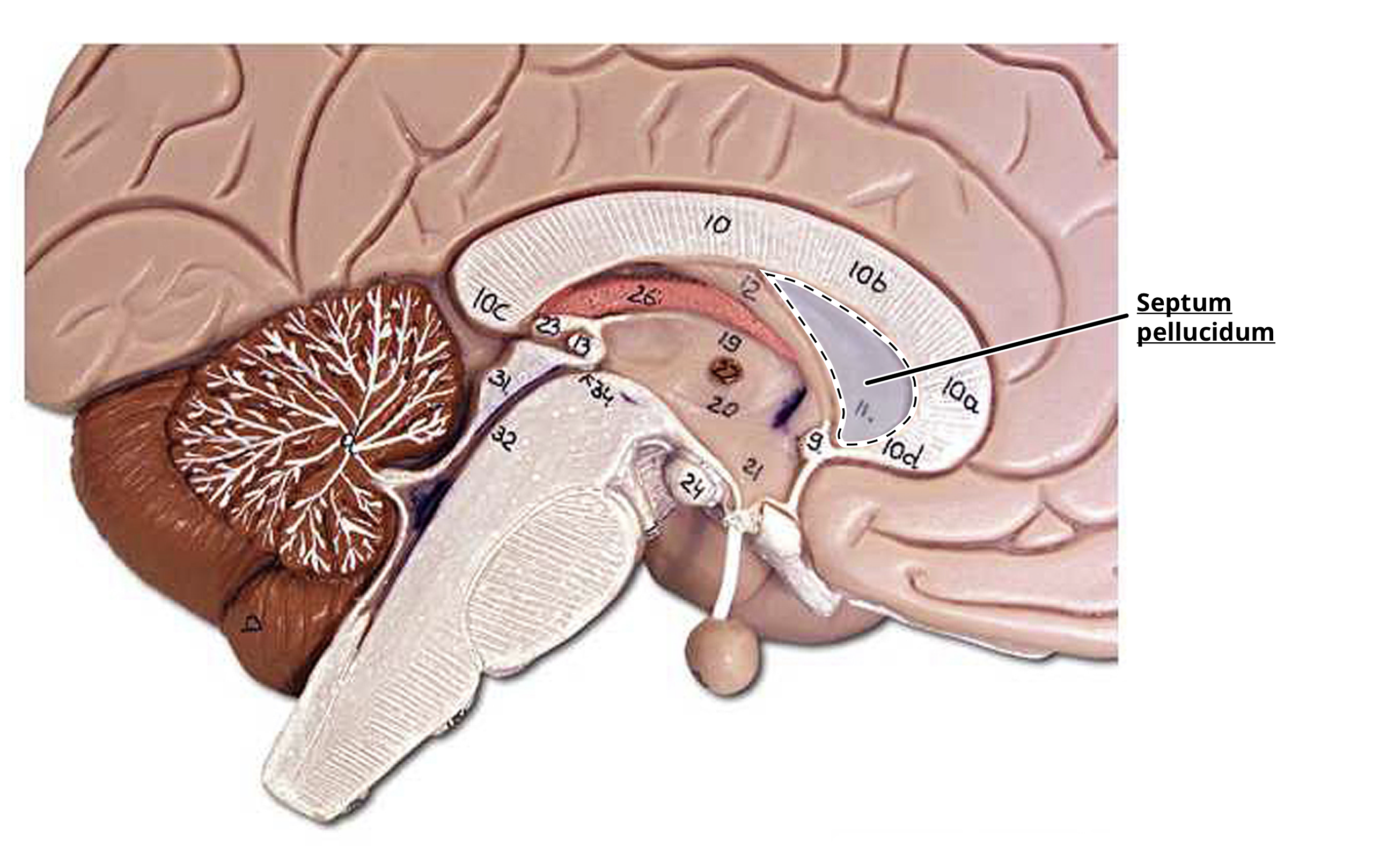 <p>septum pellucidum</p>
