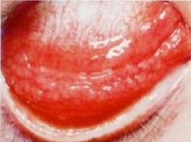 <p>lymphoid germinal centers vessels around the base</p><p>Viral = lymphadenopathy</p>