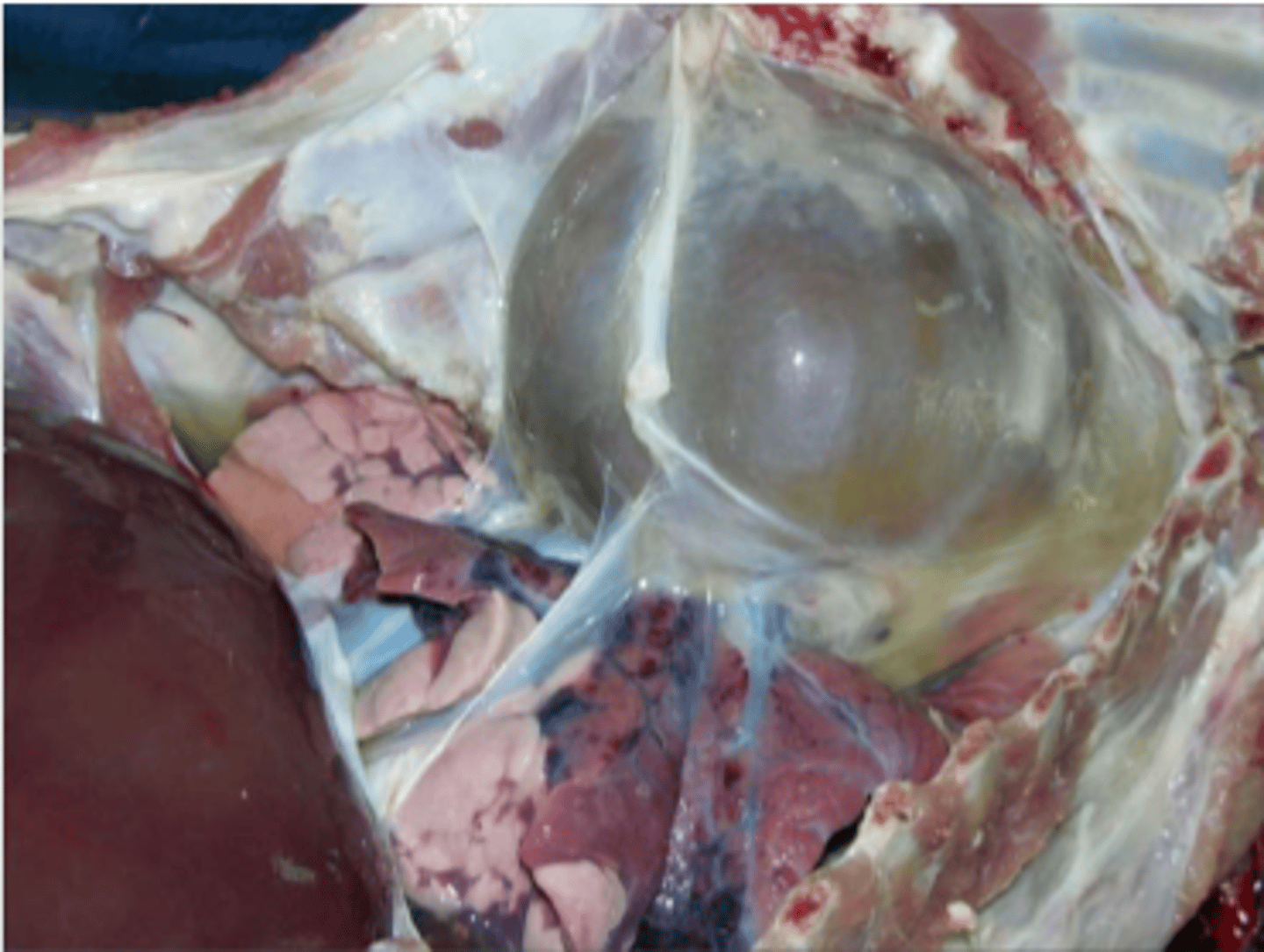 <p>______________________ occurs when there is transudate in the pericardial sac. Where are the 2 most common reasons this may occur?</p>