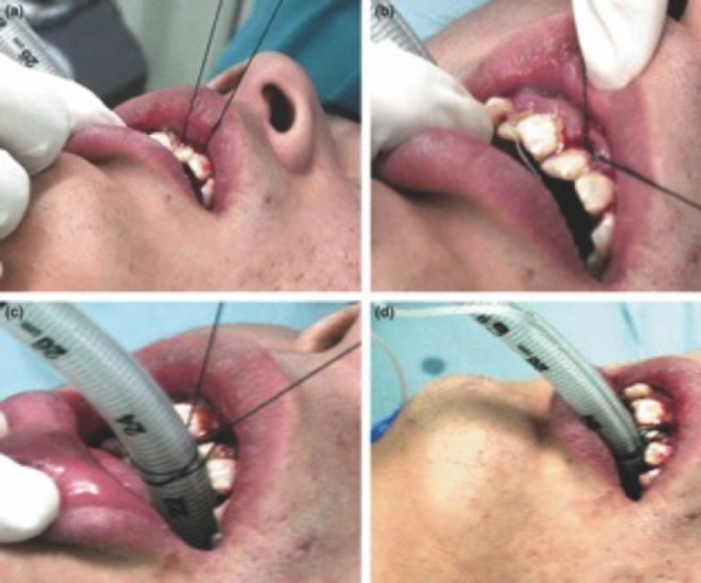 <p>wire tube to upper incisors via sutures</p>