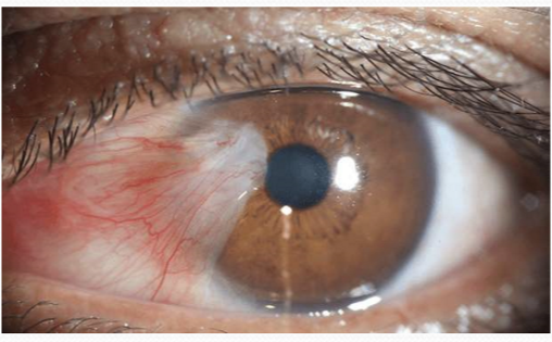 <p>The encroachment of subepithelial conj fibroblastic tissue onto the cornea involving the degradation of bowman’s layer</p>