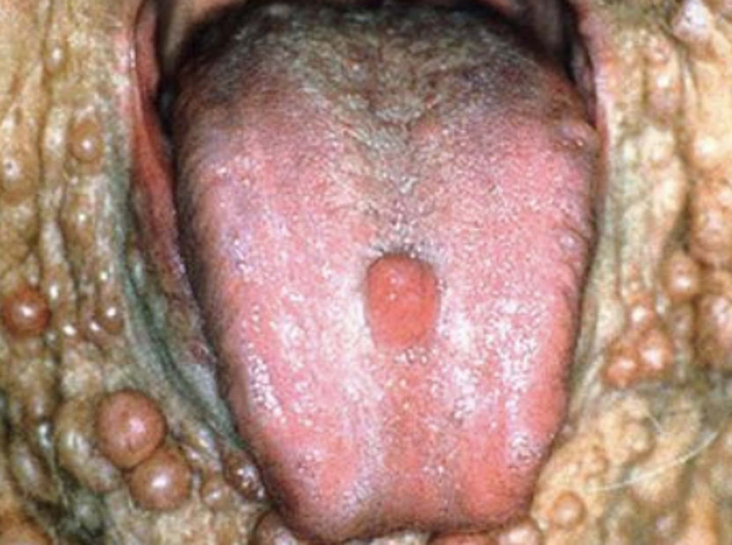 <p>Most common + presents with oral lesions</p><p>Heredity condition</p><p>Autosomal dominant</p><p>Mapped on Chromosome 17</p><p>--NF1 gene</p>