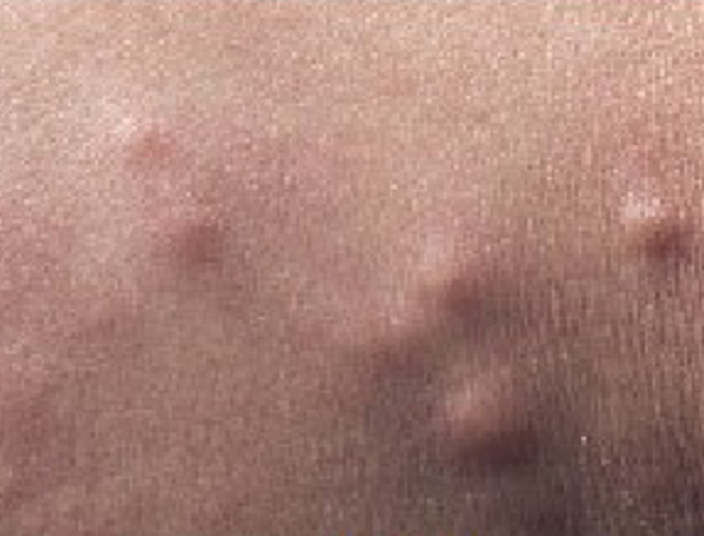 <p>= circumscriptie, solide verhevenheid van de huid &lt; 1 cm, die ontstaan is door cel-, weefsel- of vochttoename en die geneest zonder littekenvorming</p>