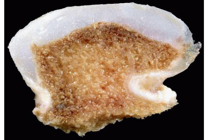 <ul><li><p>tumor van het kraakbeen</p></li><li><p>centraal gedeelte van bot, daarrond kraakbeen</p></li><li><p>tumor die ontstaat uit hyalien kraakbeen</p></li></ul><p></p>