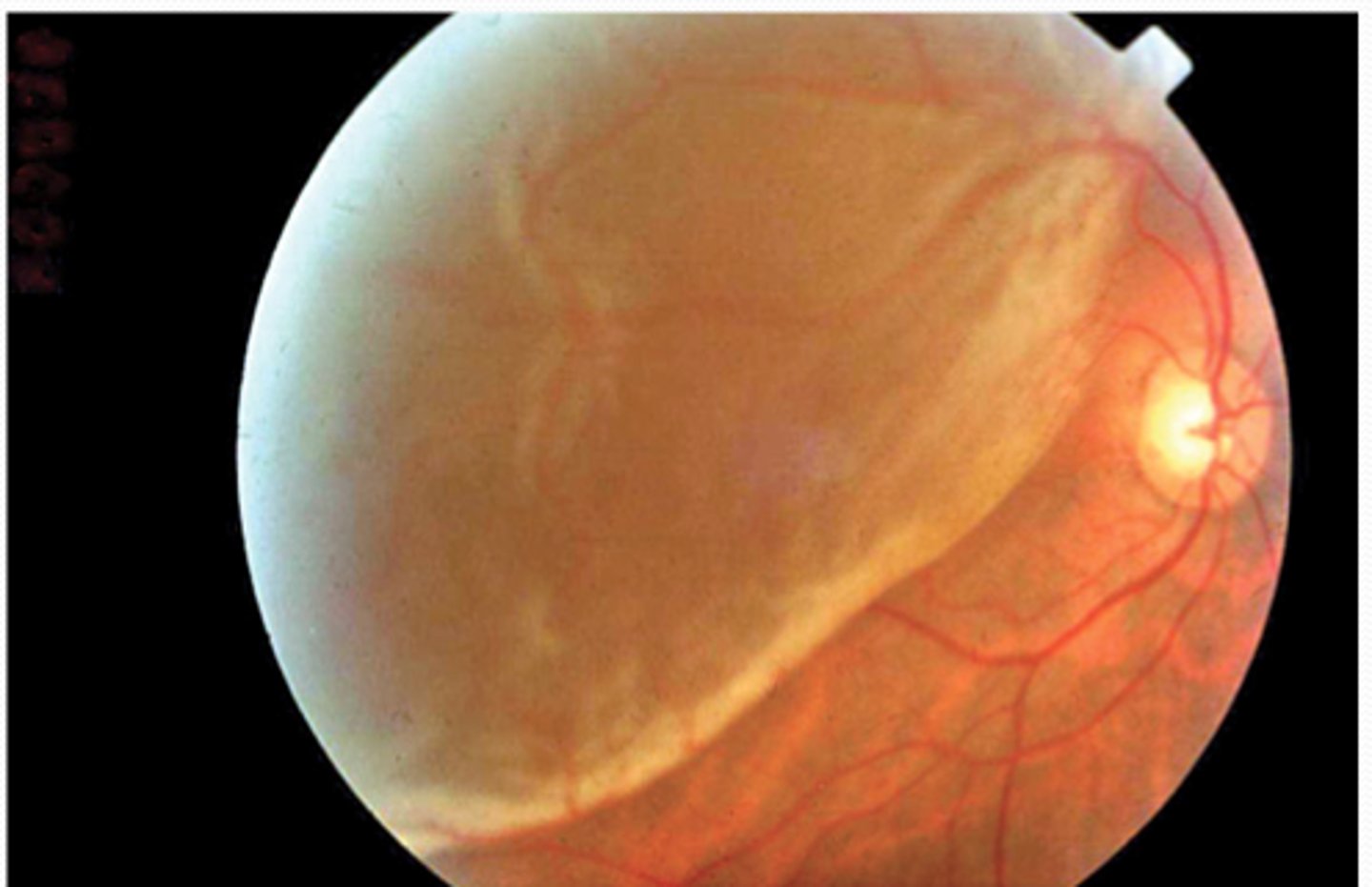 <p>separation between the pigment epithelium and the neural layers of the neural retina</p>