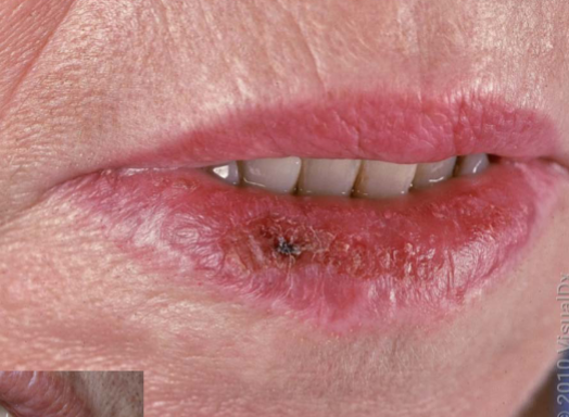 <p>actinic cheilitis characteristics </p>
