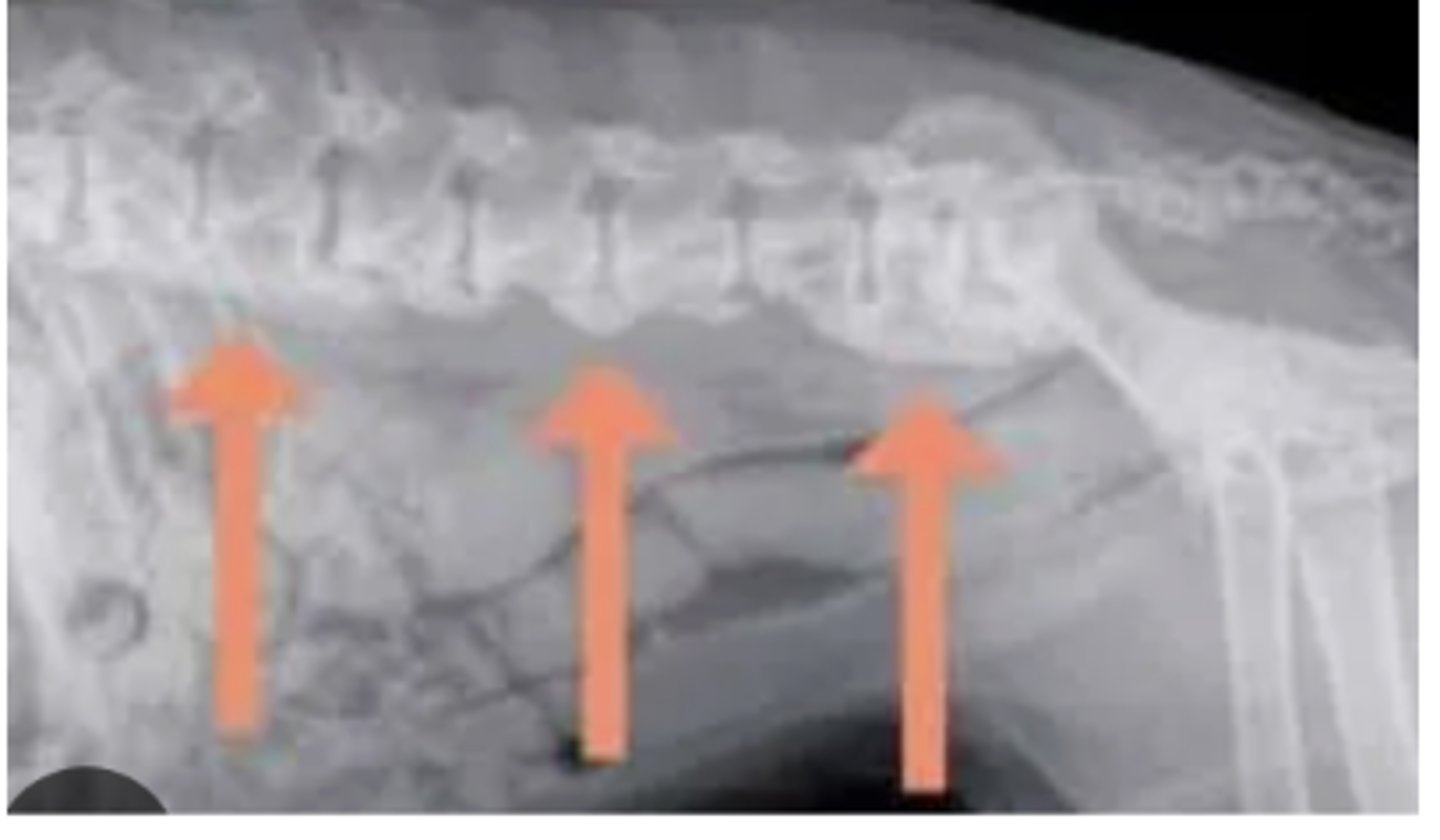 <p>What abnormality is shown in this radiograph of the spine?</p>