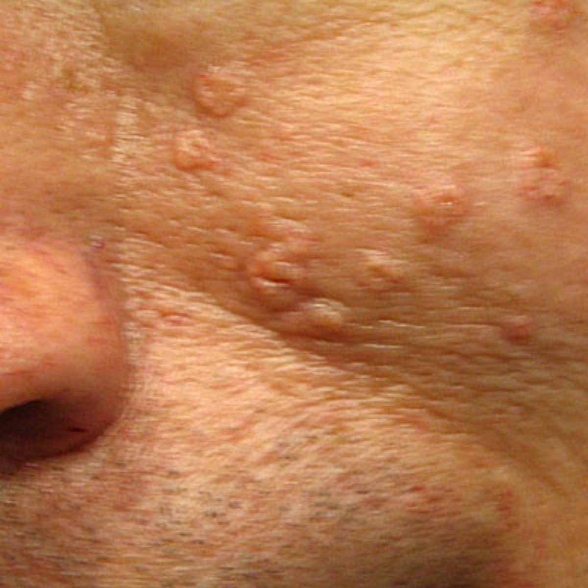 <p>is sebaceous hyperplasia associated with HPV</p>