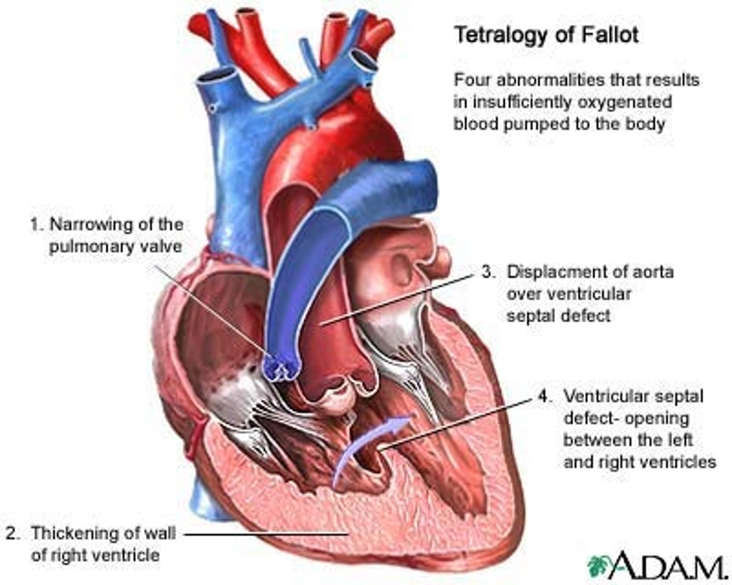 <p>Deoxygenated blood bypasses lungs and goes to body, causing Cyanosis</p>