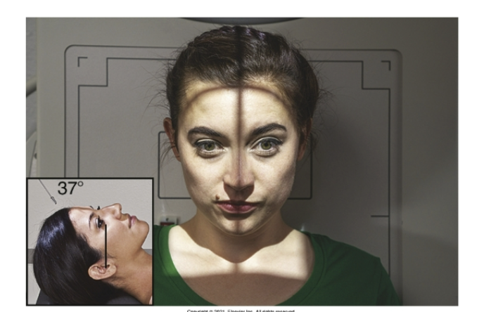 <p>What is the <u>positioning</u> of <strong>AP axial projection of Towne’s</strong> method of <strong>skull</strong>?</p>