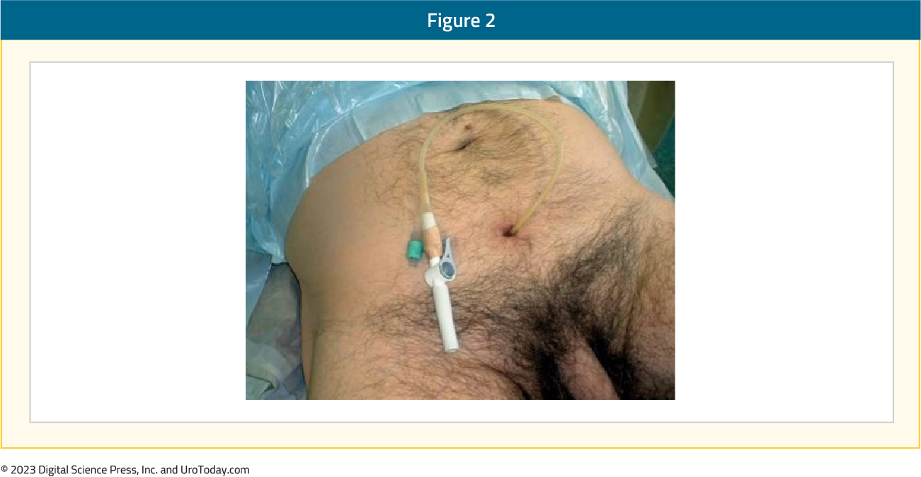 <p>How are suprapubic catheters different from conventional indwelling catheters?</p>