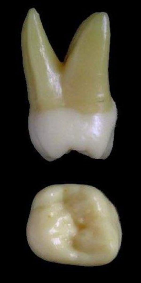 <p>what tooth is this &amp; why?</p>