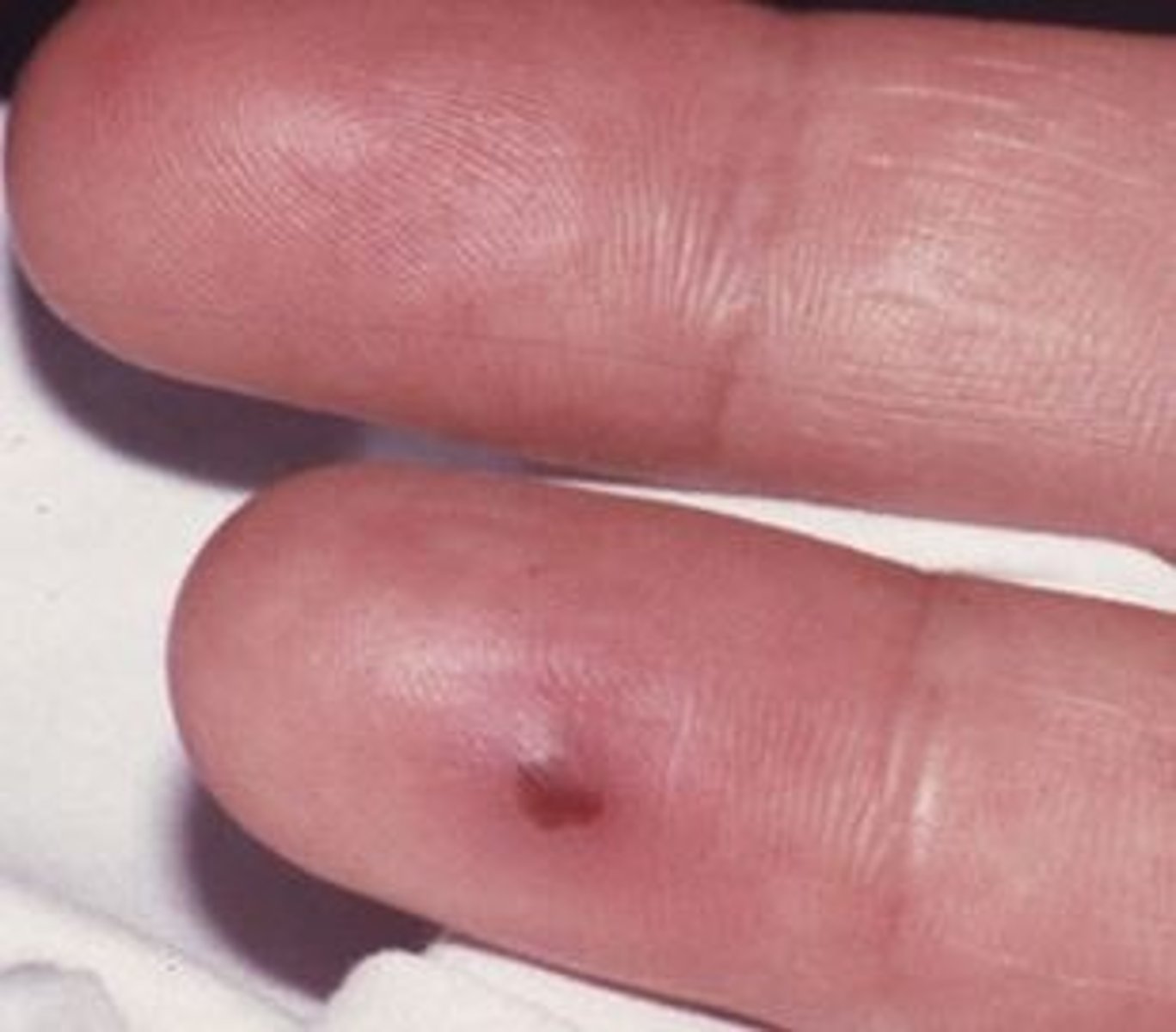 <p>red-purple, slightly raised, tender lumps, often with a pale center, typically found on the fingers or toes</p>