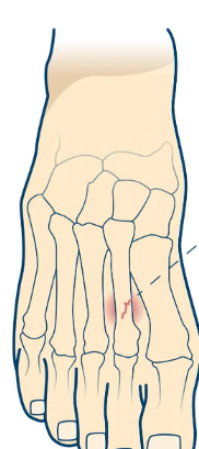 <p>tiny cracks in bone caused by repeated activity</p><p>hardest to detect</p>