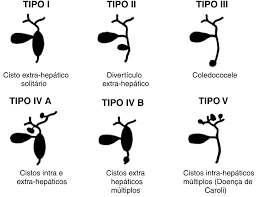 <p>ALONSO LEJ TODANI 1 dilatação árvore extra-hepática (UMsiforme, número UM em prevalência)</p><p>1a dilatação cística</p><p>1b dilatação segmentar focal</p><p>1c dilatação fusiforme</p><p>2 dilatação DIverticular (divertículo verdadeiro de colédoco)</p><p>3 dilatação cística da porção intraduodenal do colédoco (coledococele) - ÚNICO QUE NAO TEM RISCO AUMENTADO DE NEOPLASIA</p><ul><li><p>TT ESFINCTEROTOMIA COM CPRE</p></li></ul><p>4a múltiplos cistos via intra e extra</p><p>4b múltiplos cistos via extra</p><p>5 caroli (múltiplos cistos intra com ou sem fibrose portal)</p><p></p><p>TRATAMENTO </p><p>1, 2, 4 cvl + ressecção lesão e ductos extra-hepáticos + hepaticojejunostomia em y de roux</p><p>3 esfincterotomia</p><p>5 hepatec/tx/ colangiografias percutâneas para tratamento hepatolitíase</p>