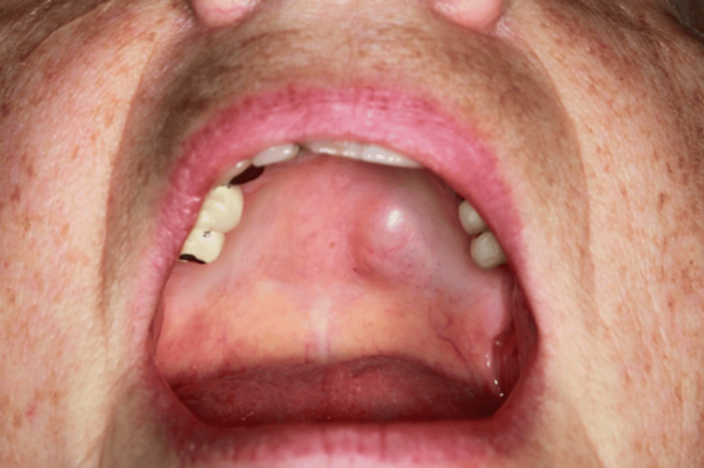 <p>Patient presents with large nodule on the roof of the mouth. Patient recalls accidentally biting hard onto a fish bone that perforated the palatal mucosa. Biopsy reveals it to a neuroma. Patient returns to office after 7 months and a 2nd similar nodule has developed. What must the patient be worked up for?</p>